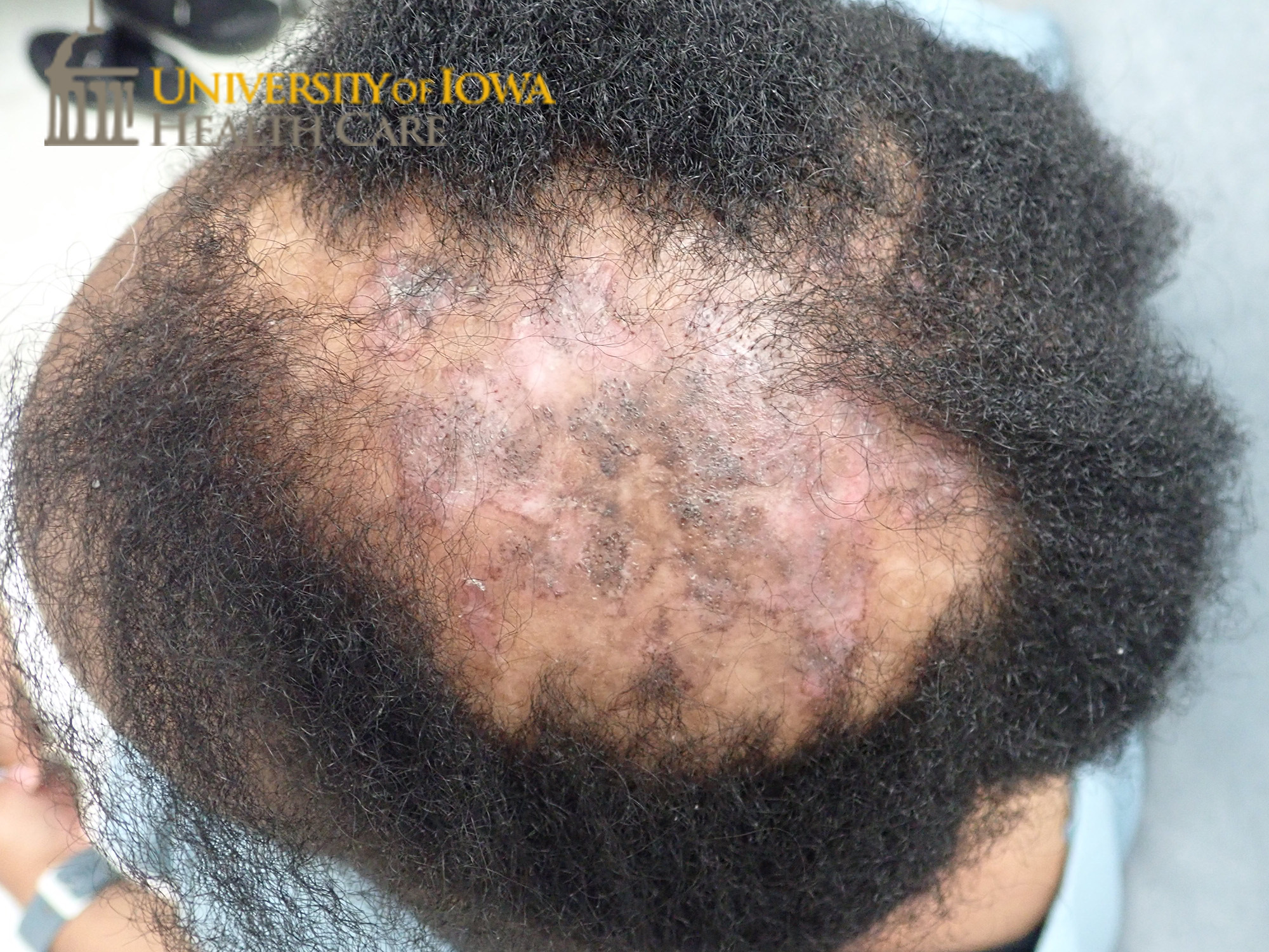 Atrophic, pink to violaceous plaque with focal areas of scale and associated scarring alopecia on the crown scalp. (click images for higher resolution).